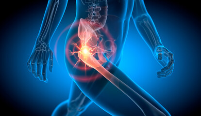 Walking man painful hip joint with blue background- x-ray illustration