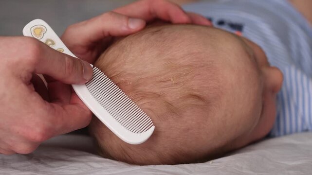 Father's hands with comb gentle removing cradle cap of seborrheic dermatitis of baby's head.