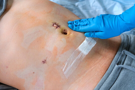 Hands of medic or nurse in blue gloves examining a fresh suture on a male stomach after laparoscopy surgical removal of appendicitis. Doctor examines of the patient. Man belly with medical stitches