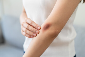 Close-up purple bruised on the arm of human from accident.