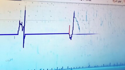 Restoring Heart Rate After Cardiac Arrest on Electrocardiogram Display Generative AI