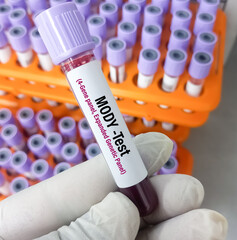 Blood sample for MODY or Maturity-Onset Diabetes of the Young test to diagnose neonatal diabetes...