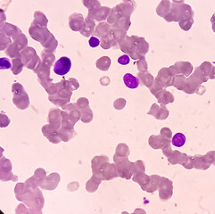Bone marrow study (BMS). Secondary metastasis  in bone marrow. Cancer cell. Oncology, cancerology,...