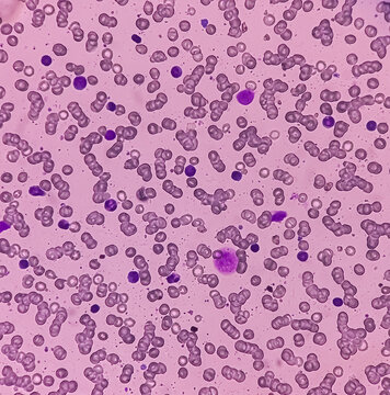 Bone marrow study (BMS). Secondary metastasis  in bone marrow. Cancer cell. Oncology, cancerology, Bone marrow (BM) metastasis (BMM).