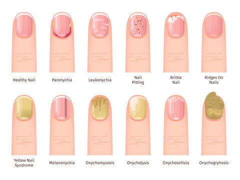 Nail Diseases. Health painful sickness or injured nails problem, fingernail infections conditions treatment medical dermatology diagnosis illness finger, swanky Vector Illustration