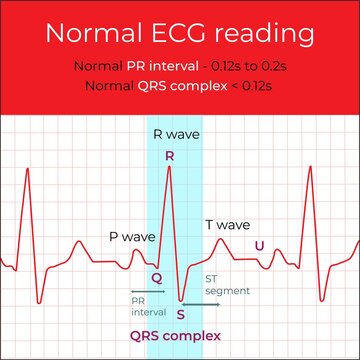 Elecrocardiograme Normal ECG reading, QRS complex, PR interval