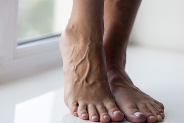 Varicose veins on the female feet. Closeup.