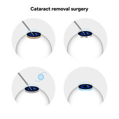 Cataract removal surgery icons
