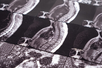 MRI of a patient with intervertebral disc protrusion and osteochondrosis of the thoracic spine