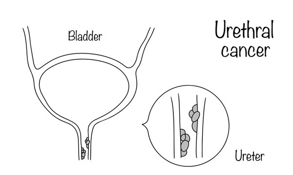 Urethral cancer