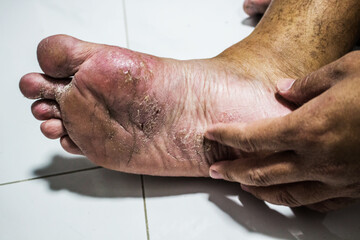 Men's feet with fungus, The skin peels off into wounds, Athlete's Foot, Tinea pedis, Fungal...