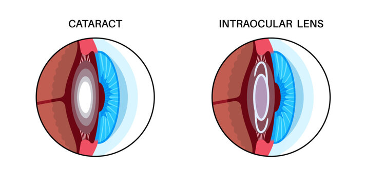 Intraocular lenses poster