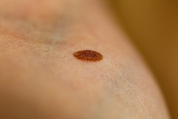 Closeup brown mole on skin.