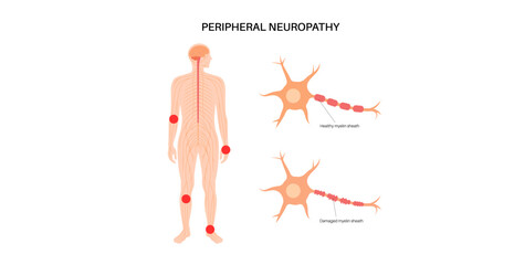 Peripheral neuropathy medical poster