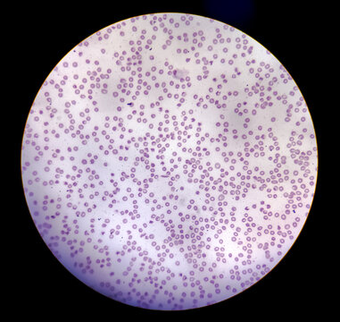 Anisocytosis anisochromia with both microcytic hypochromic and macrocytic hypochromic RBC with rouleaux formation, Dimorphic anemia