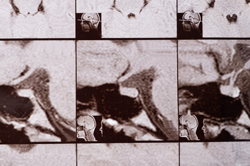 Magnetic resonance imaging of the head of a healthy person, image of the pituitary gland.