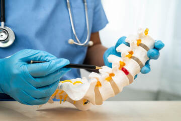Doctor holding lumbar vertebrae spine skeleton bone and spinal nerve with displaced herniated disc...