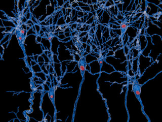 Neurons with Lewy bodies