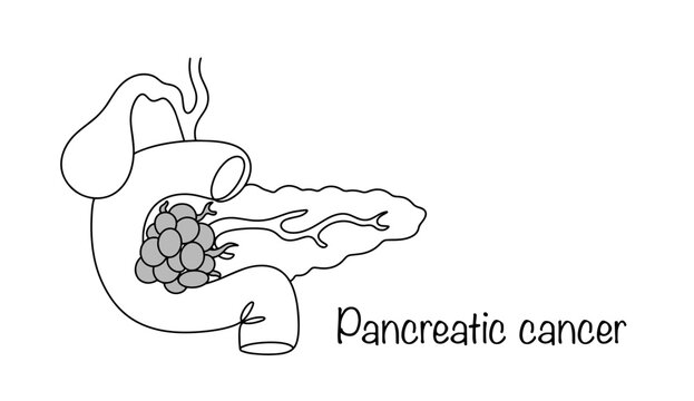 Pancreatic cancer