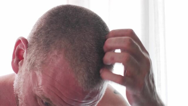 Itchy scalp. Caucasian man itching and scratching his head. Itchiness skin problem. How to fix your dry itchy scalp and healthcare and medical concept.