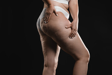 Naklejka premium Woman with cellulite on black background, closeup
