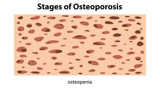 Stages of Osteoporosis Progression