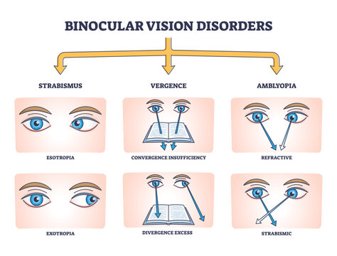Binocular vision disorders with all eye defect examples outline diagram, transparent background. Labeled educational anatomical strabismus, vergence and amblyopia division illustration.