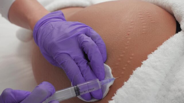 Aesthetic procedure for removing wrinkles on the buttocks with a syringe, performed by a professional. Procedure for removing stretch marks on the skin with injections in a cosmetic clinic