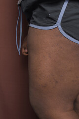 Eczema on brown skin leg, brown skin with hyperpigmentation and scarring from eczema and atopic...