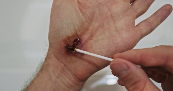 Man smears a wound on his palm with iodine solution, disinfection. Self-treatment of skin after falling on asphalt, close-up