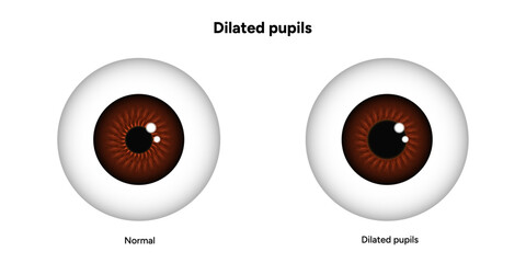 Dilated pupils eye diseases ophthalmology