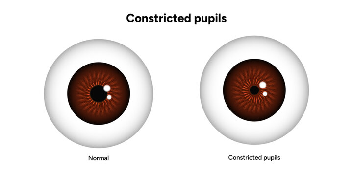 Constricted pupils eye diseases ophthalmology