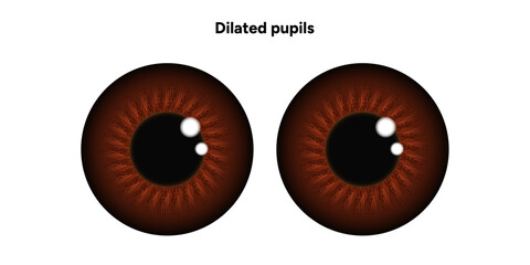 Dilated pupils eye diseases ophthalmology