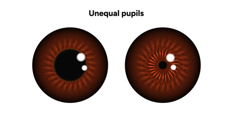 Unequal pupils eye diseases ophthalmology