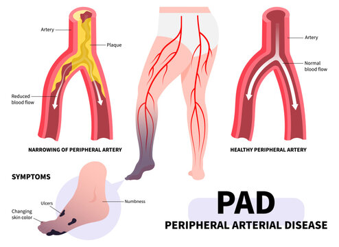 Foot ulcer with Peripheral artery disease and fatty clot in leg veins or injury pain high blood pressure