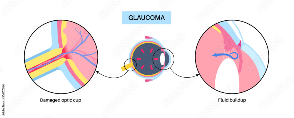 Canvas Prints Glaucoma eye disease