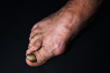 A close-up toenail suffering from onycholysis, characterized by its separation from the nail bed.