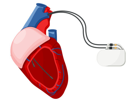 Medical equipment, pacemakers cardiac external temporary permanent system used to pace the heart using electrical impulses. Flat design