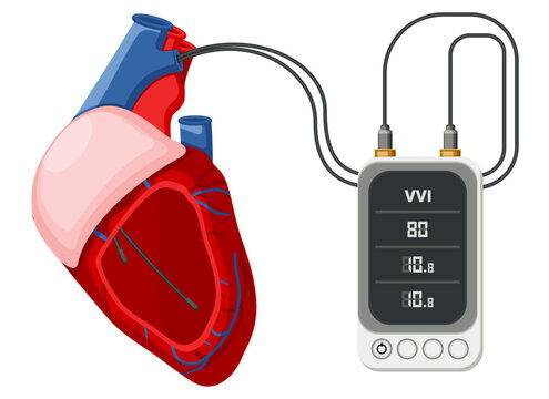Medical equipment, pacemakers cardiac external temporary permanent system used to pace the heart using electrical impulses. Flat design