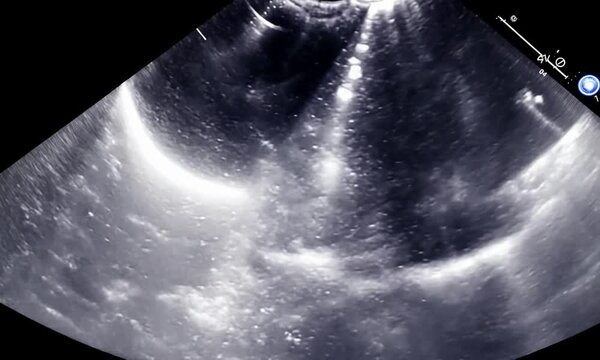 Ultrasound Scan Image of a Human Heart