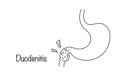 Fototapeta premium Duodenitis