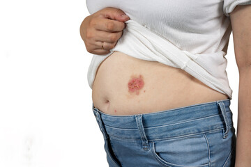 A wound, a burn on his stomach. Dermatology Skin Issues, skin problems, health care, human tissue...