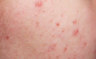 Pimple on face. Skin texture. Closeup acne skin. Treatment for skin. Problem skincare. Pimples,...