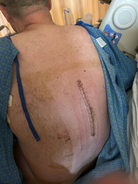 Sutures