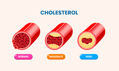 Comparison of normal blood flow and blood vessels with cholesterol deposits, leading to atherosclerosis and myocardial infarction. Vector illustration.