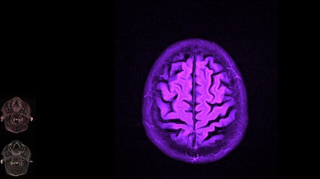 Magnetic resonance imaging of the brain. MRI of the brain. Medical examination of the human brain. Coronal brain MRI for diagnosis of neurological disorders