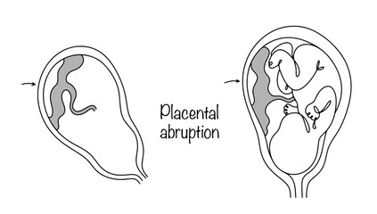 Placental abruption