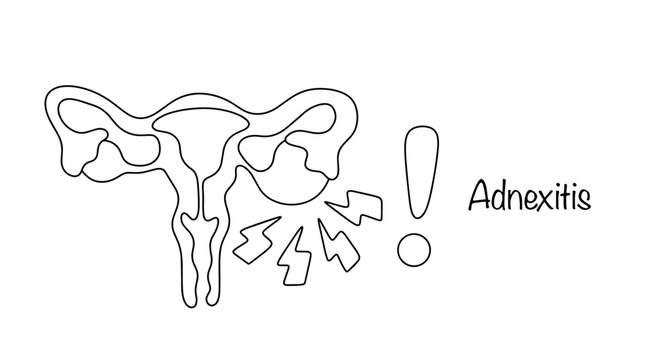 Adnexitis