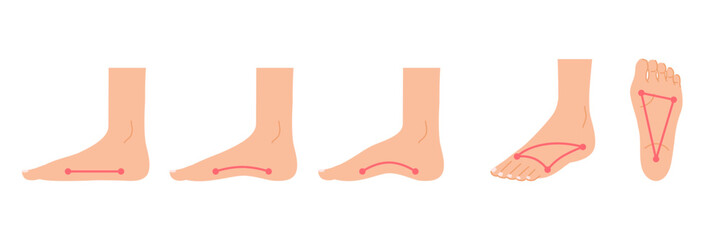 足のアーチ：足の甲と足裏と側面のイラストセット（正常とアーチ崩れ）