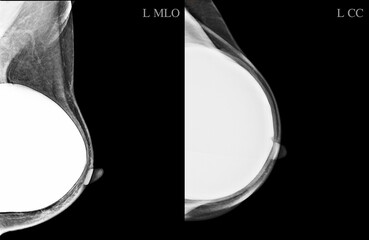 The mammogram BI-RADS 2-benign shows a breast implant augmentation .